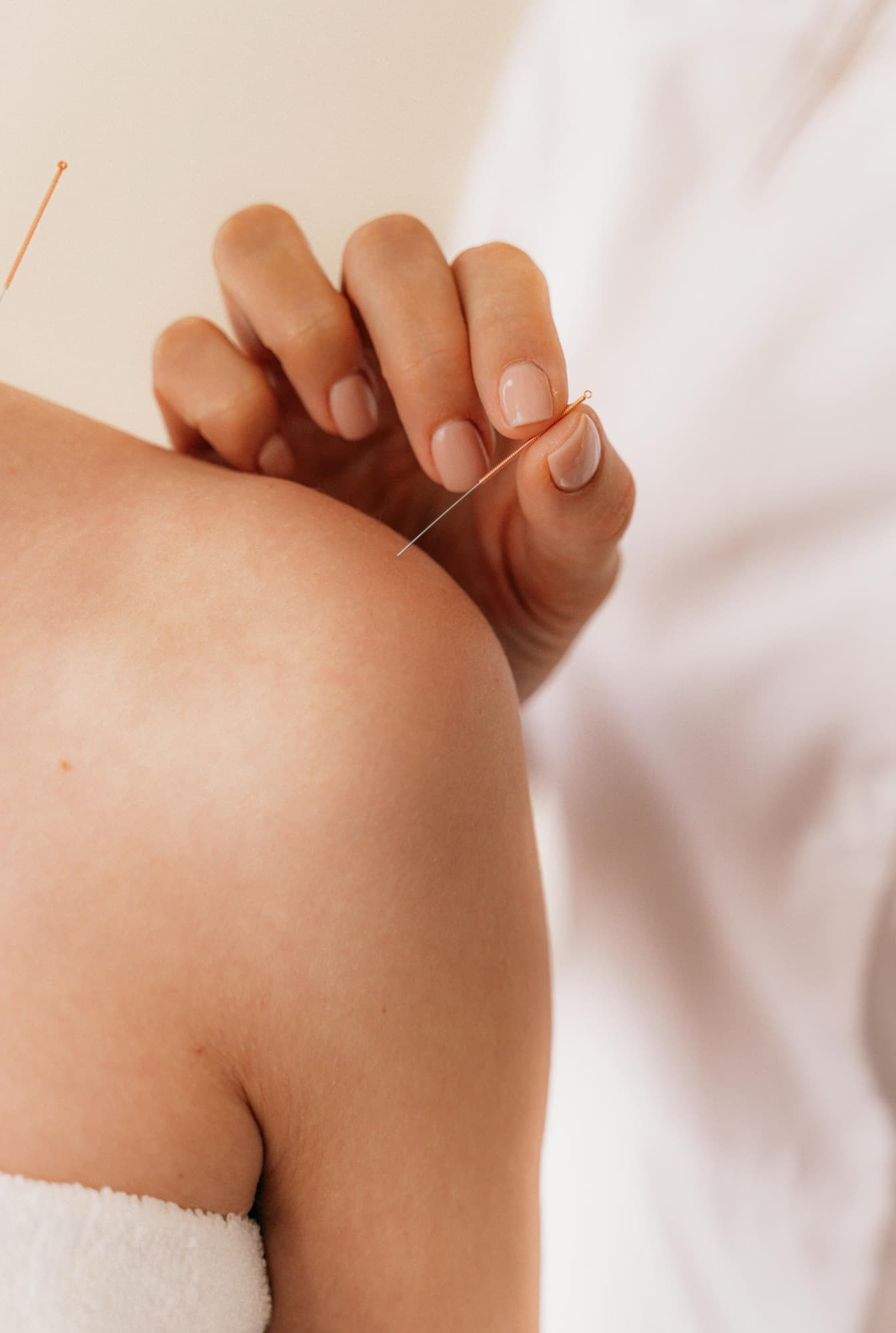 Dry needling treatment